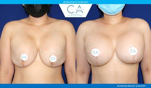 Breast Lift result at CA Aesthetics: Bay Area Plastic Surgery Eric Li, MD in Campbell, CA