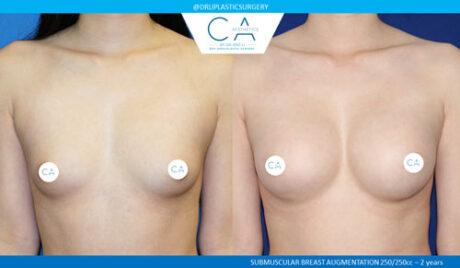 Breast Augmentation result at CA Aesthetics: Bay Area Plastic Surgery Eric Li, MD in Campbell, CA