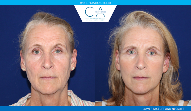 Facelift result at CA Aesthetics: Bay Area Plastic Surgery Eric Li, MD in Campbell, CA
