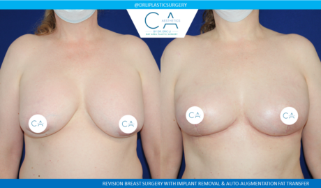 Fat Transfer result at CA Aesthetics: Bay Area Plastic Surgery Eric Li, MD in Campbell, CA