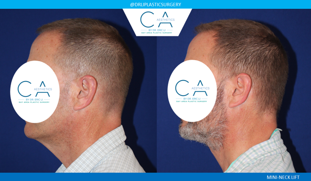 Facelift result at CA Aesthetics: Bay Area Plastic Surgery Eric Li, MD in Campbell, CA