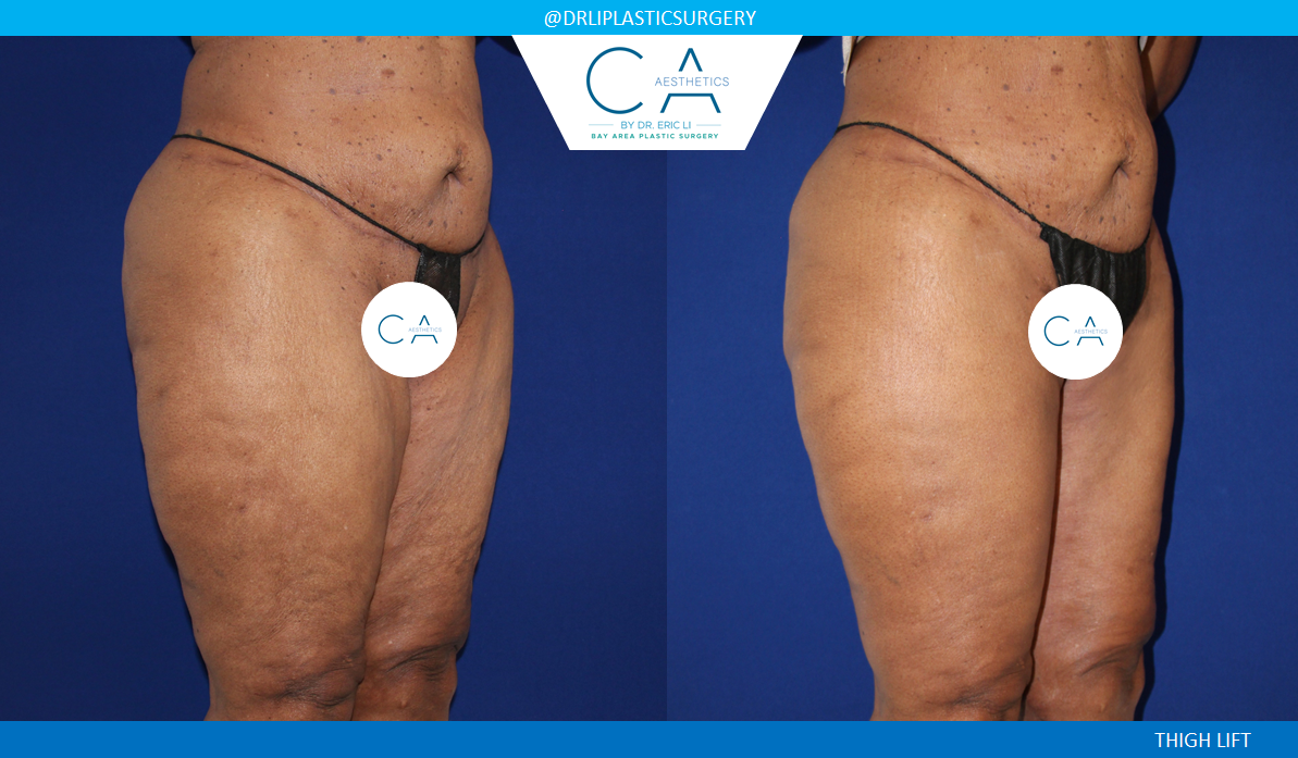 CA Aesthetics: Bay Area Plastic Surgery Eric Li, MD thigh lift result — Campbell, CA