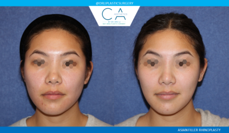 Rhinoplasty result at CA Aesthetics: Bay Area Plastic Surgery Eric Li, MD in Campbell, CA