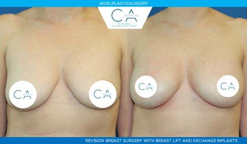 Breast Lift result at CA Aesthetics: Bay Area Plastic Surgery Eric Li, MD in Campbell, CA