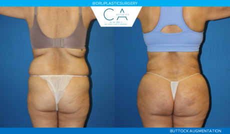 CA Aesthetics: Bay Area Plastic Surgery Eric Li, MD bbl result — Campbell, CA