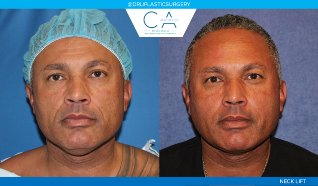 Facelift result at CA Aesthetics: Bay Area Plastic Surgery Eric Li, MD in Campbell, CA
