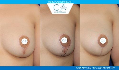 Breast Lift result at CA Aesthetics: Bay Area Plastic Surgery Eric Li, MD in Campbell, CA
