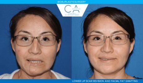 CA Aesthetics: Bay Area Plastic Surgery Eric Li, MD result — Campbell, CA
