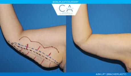 CA Aesthetics: Bay Area Plastic Surgery Eric Li, MD result — Campbell, CA