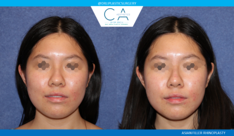 Rhinoplasty result at CA Aesthetics: Bay Area Plastic Surgery Eric Li, MD in Campbell, CA