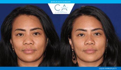 Rhinoplasty result at CA Aesthetics: Bay Area Plastic Surgery Eric Li, MD in Campbell, CA