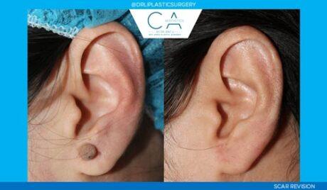 CA Aesthetics: Bay Area Plastic Surgery Eric Li, MD result — Campbell, CA