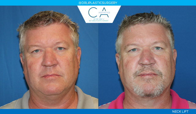 Facelift result at CA Aesthetics: Bay Area Plastic Surgery Eric Li, MD in Campbell, CA
