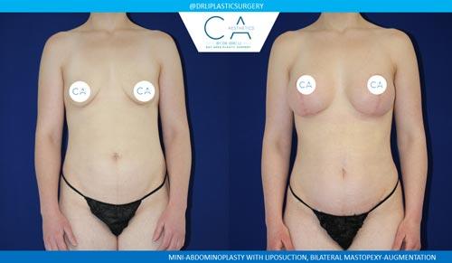 Mommy Makeover result at CA Aesthetics: Bay Area Plastic Surgery Eric Li, MD in Campbell, CA
