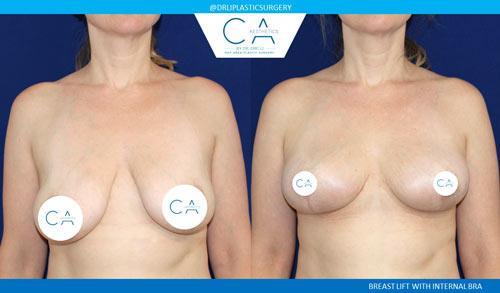 Breast Lift result at CA Aesthetics: Bay Area Plastic Surgery Eric Li, MD in Campbell, CA