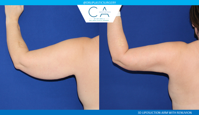 Arm Lift result at CA Aesthetics: Bay Area Plastic Surgery Eric Li, MD in Campbell, CA