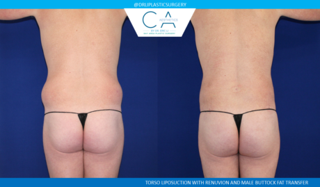 CA Aesthetics: Bay Area Plastic Surgery Eric Li, MD bbl result — Campbell, CA