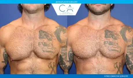 CA Aesthetics: Bay Area Plastic Surgery Eric Li, MD gynecomastia result — Campbell, CA