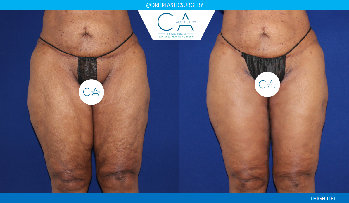 CA Aesthetics: Bay Area Plastic Surgery Eric Li, MD thigh lift result — Campbell, CA