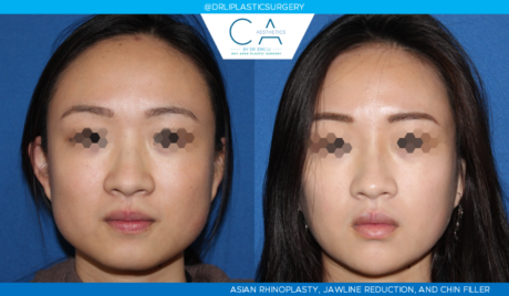 Rhinoplasty result at CA Aesthetics: Bay Area Plastic Surgery Eric Li, MD in Campbell, CA