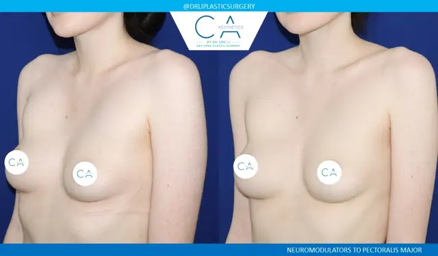 Botox result at CA Aesthetics: Bay Area Plastic Surgery Eric Li, MD in Campbell, CA