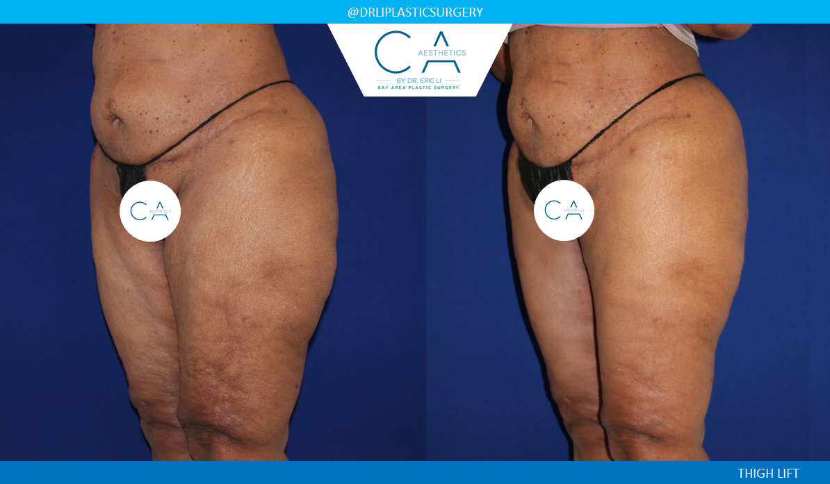 CA Aesthetics: Bay Area Plastic Surgery Eric Li, MD thigh lift result — Campbell, CA