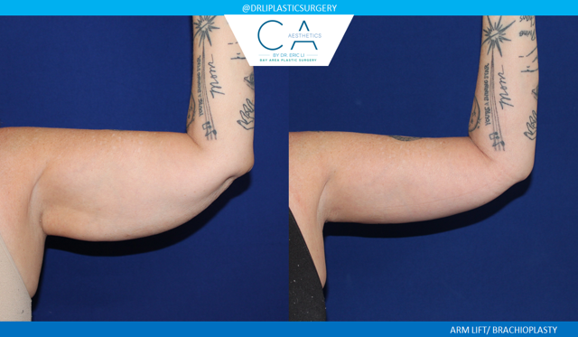 Arm Lift result at CA Aesthetics: Bay Area Plastic Surgery Eric Li, MD in Campbell, CA
