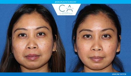 CA Aesthetics: Bay Area Plastic Surgery Eric Li, MD skin tightening result — Campbell, CA