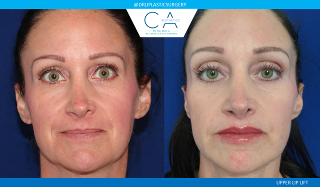 Facelift result at CA Aesthetics: Bay Area Plastic Surgery Eric Li, MD in Campbell, CA