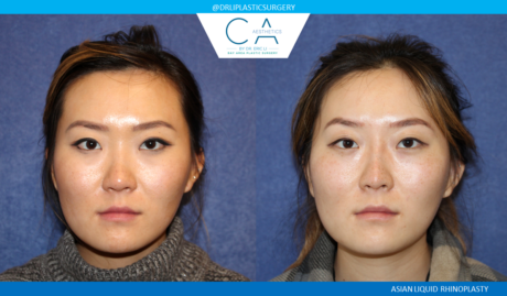 Rhinoplasty result at CA Aesthetics: Bay Area Plastic Surgery Eric Li, MD in Campbell, CA