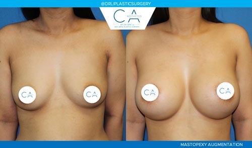 Breast Lift result at CA Aesthetics: Bay Area Plastic Surgery Eric Li, MD in Campbell, CA