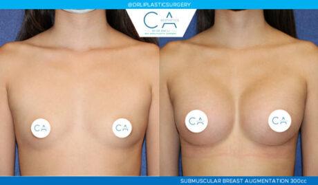 Breast Augmentation result at CA Aesthetics: Bay Area Plastic Surgery Eric Li, MD in Campbell, CA