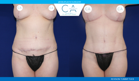 Tummy Tuck result at CA Aesthetics: Bay Area Plastic Surgery Eric Li, MD in Campbell, CA