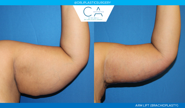 Arm Lift result at CA Aesthetics: Bay Area Plastic Surgery Eric Li, MD in Campbell, CA