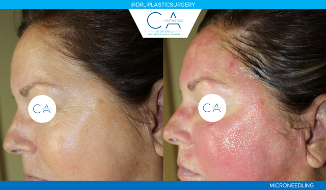 Microneedling result at CA Aesthetics: Bay Area Plastic Surgery Eric Li, MD in Campbell, CA