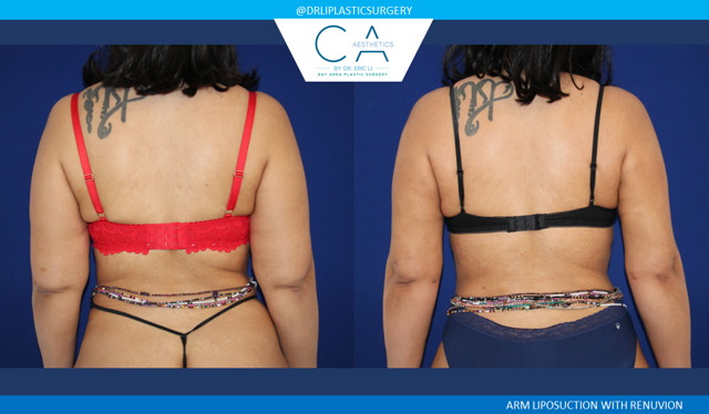 Arm Lift result at CA Aesthetics: Bay Area Plastic Surgery Eric Li, MD in Campbell, CA