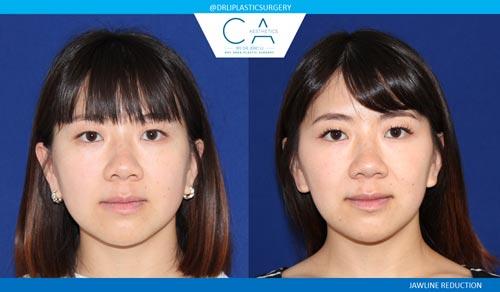 CA Aesthetics: Bay Area Plastic Surgery Eric Li, MD skin tightening result — Campbell, CA