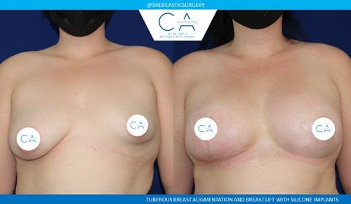 Breast Lift result at CA Aesthetics: Bay Area Plastic Surgery Eric Li, MD in Campbell, CA