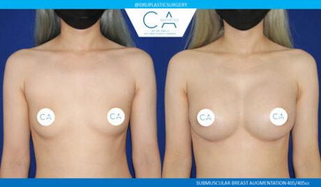 Breast Augmentation result at CA Aesthetics: Bay Area Plastic Surgery Eric Li, MD in Campbell, CA