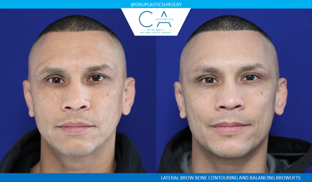 Brow Lift result at CA Aesthetics: Bay Area Plastic Surgery Eric Li, MD in Campbell, CA