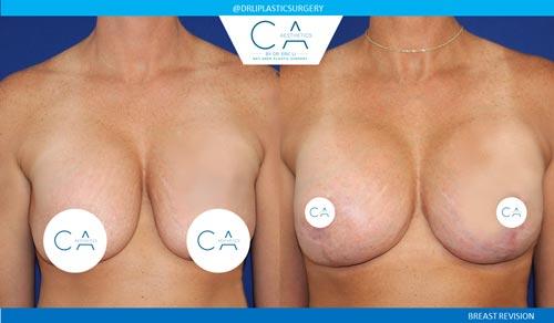 Breast Lift result at CA Aesthetics: Bay Area Plastic Surgery Eric Li, MD in Campbell, CA