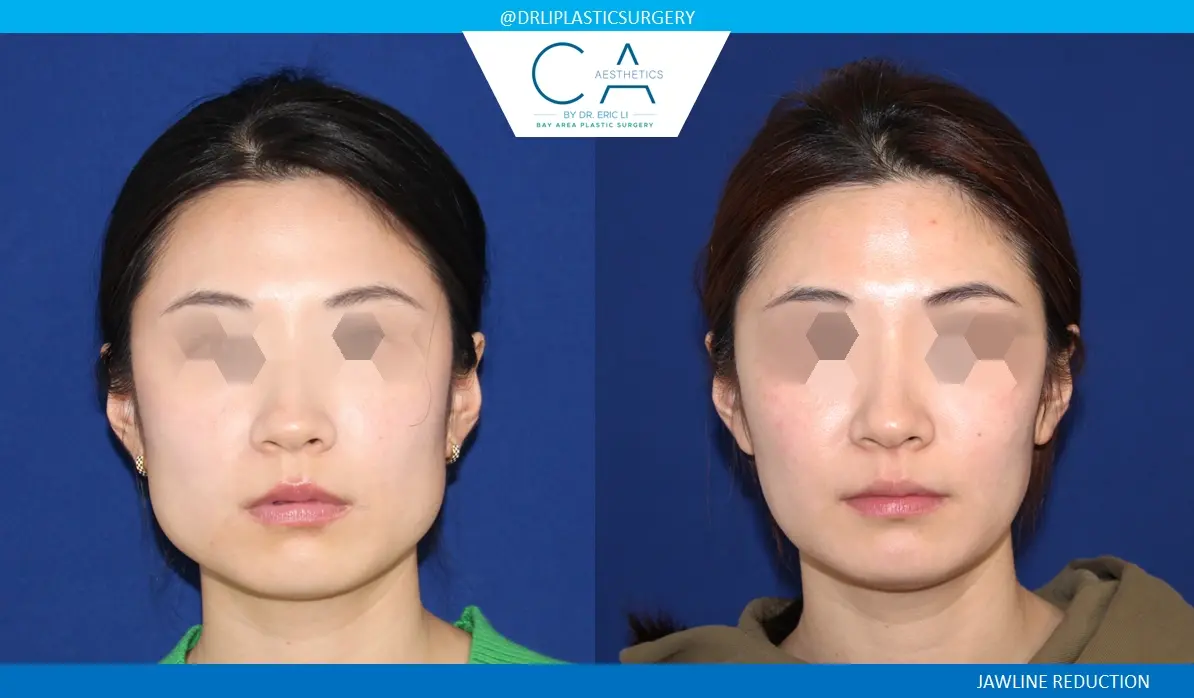 CA Aesthetics: Bay Area Plastic Surgery Eric Li, MD skin tightening result — Campbell, CA