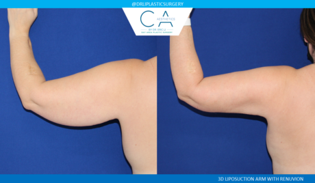 Liposuction result at CA Aesthetics: Bay Area Plastic Surgery Eric Li, MD in Campbell, CA