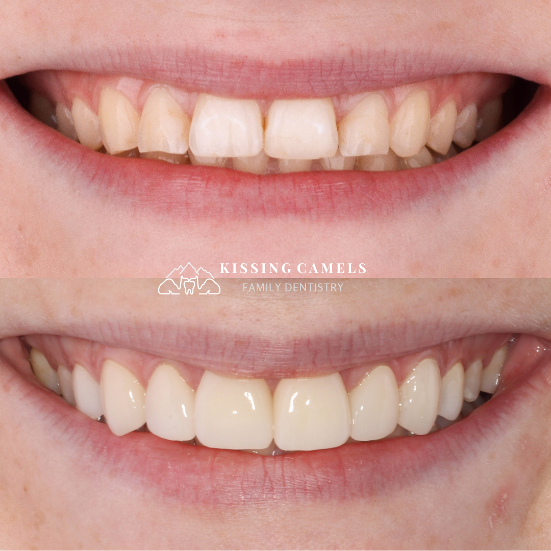 Kissing Camels Family Dentistry veneers result — Colorado Springs, CO