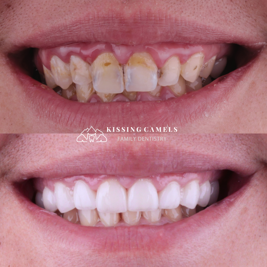 Kissing Camels Family Dentistry veneers result — Colorado Springs, CO