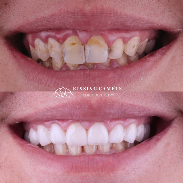 Invisalign result at Kissing Camels Family Dentistry in Colorado Springs, CO