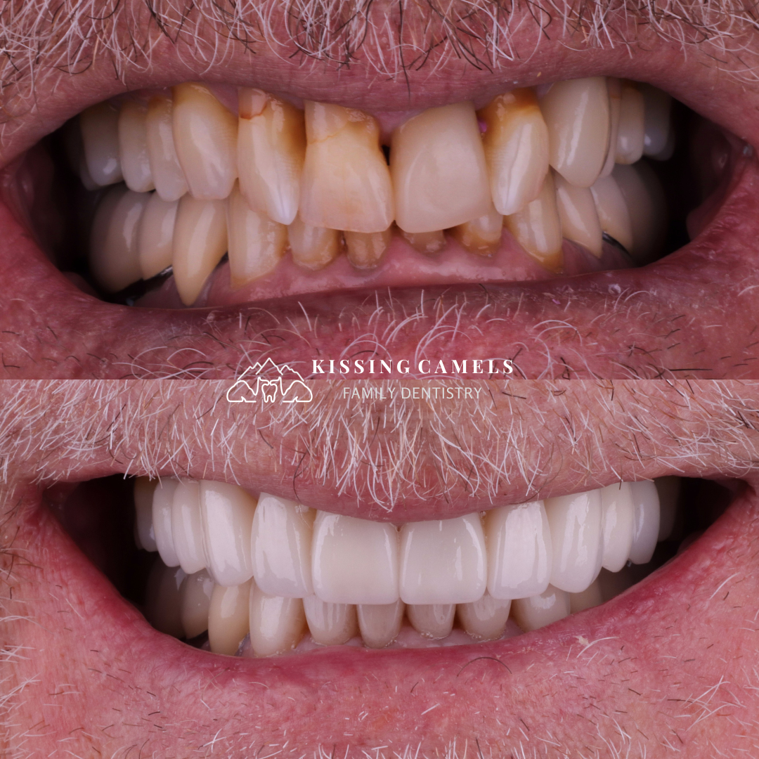 Kissing Camels Family Dentistry veneers result — Colorado Springs, CO