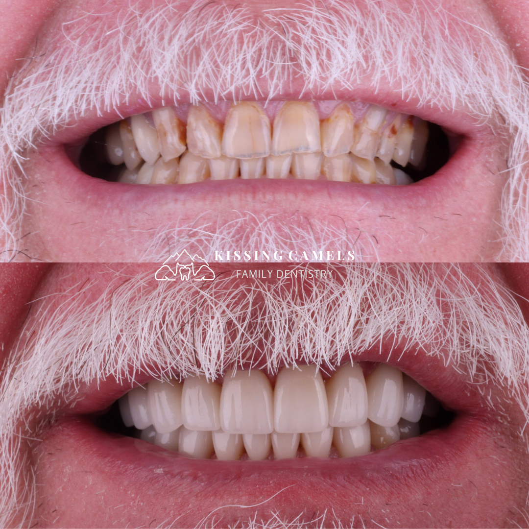 Kissing Camels Family Dentistry veneers result — Colorado Springs, CO