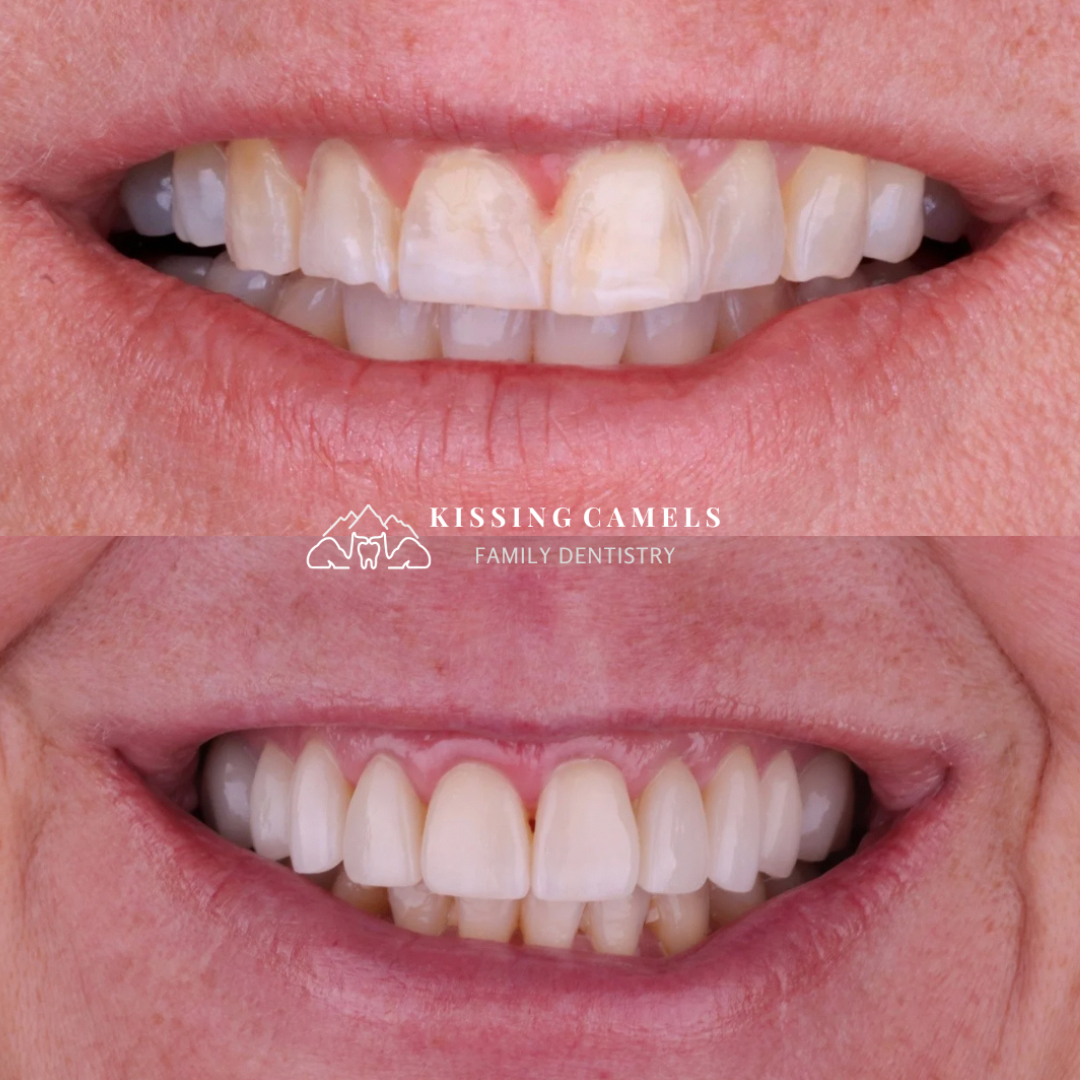 Kissing Camels Family Dentistry veneers result — Colorado Springs, CO