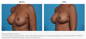 Breast Augmentation result at Bradley Hubbard, MD in Plano, TX